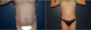 39 Year Old Woman Treated With Tummy Tuck By Dr Farhad Rafizadeh, MD, Morristown Plastic Surgeon