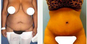 39 Year Old Woman Treated With Tummy Tuck Liposuction With Dr. Daniel Zeichner, MD, Plantation Plastic Surgeon
