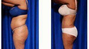 39 Year Old Woman Treated With Tummy Tuck With Doctor Jules Walters, MD, New Orleans Plastic Surgeon
