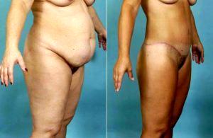 39yo Female, Abdominoplasty Flankplasty With Dr Steven J. Smith, MD, Knoxville Plastic Surgeon
