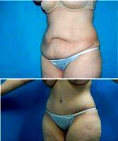 4 Month Post Operative Abdominoplasty By Dr Norman G. Morrison, MD, FACS, New York Plastic Surgeon