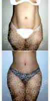 40 Year Old Woman Treated With Tummy Tuck By Doctor Jose Hungria, MD, Dominican Republic Plastic Surgeon