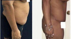 40 Year Old Woman Treated With Tummy Tuck By Dr Alex Campbell, MD, Colombia Plastic Surgeon