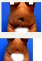 40 Year Old Woman Treated With Tummy Tuck By Dr Ruth Celestin, MD, Atlanta Plastic Surgeon