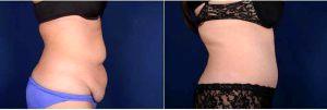 40 Year Old Woman Treated With Tummy Tuck By Dr. Rady Rahban, MD, Los Angeles Plastic Surgeon