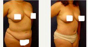 40 Year Old Woman Treated With Tummy Tuck With Doctor Arian Mowlavi, MD, FACS, Orange County Plastic Surgeon