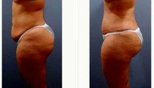 41 Year Old Woman Treated With Tummy Tuck By Doctor Bruce K. Smith, MD, Houston Plastic Surgeon