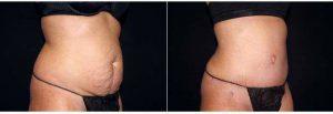 41 Year Old Woman Treated With Tummy Tuck With Circumferential Liposuction By Dr Landon Pryor, MD, FACS, Rockford Plastic Surgeon