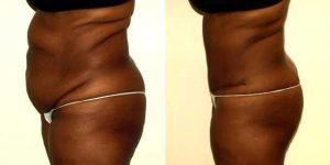 41 Year Old Woman Treated With Tummy Tuck With Doctor Cynthia L. Mizgala, MD, Metairie Plastic Surgeon