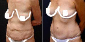 41 Year Old Woman Treated With Tummy Tuck With Doctor Mokhtar Asaadi, MD, West Orange Plastic Surgeon