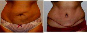41 Year Old Woman Treated With Tummy Tuck With Doctor Robert Kratschmer, MD, Houston Plastic Surgeon