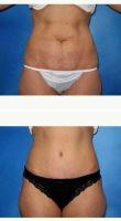 41 Yr Old Female - Tummy Tuck With Liposuction Of The Flanks By Dr Robert Frank, MD, Munster Plastic Surgeon