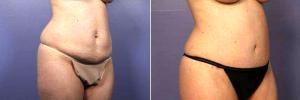 41 Yr Old Tummy Tuck And Liposuction With Dr Grant Stevens, MD, Los Angeles Plastic Surgeon