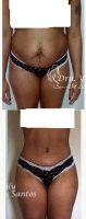 42 Year Old Woman Treated With Tummy Tuck By Dr. Yily De Los Santos, MD, Dominican Republic Plastic Surgeon