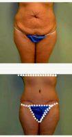 42 Year Old Woman Treated With Tummy Tuck With Doctor W. John Bull, MD, Chicago Plastic Surgeon