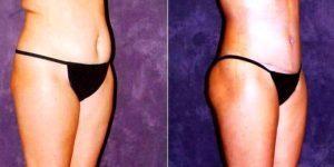 43 Year Old Woman Treated With Tummy Tuck By Dr Paul Fortes, MD, Houston Plastic Surgeon