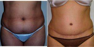 43 Year Old Woman Treated With Tummy Tuck With Doctor Gary Lawton, MD, FACS, San Antonio Plastic Surgeon