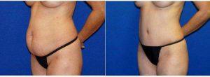 44 Year Old Woman Treated With Tummy Tuck And Contour Liposuction By Dr. Daniel Brown, MD, FACS, La Jolla Plastic Surgeon
