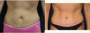 44 Year Old Woman Treated With Tummy Tuck By Doctor Pramit Malhotra, MD, Ann Arbor Plastic Surgeon