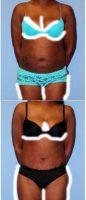 44 Year Old Woman Treated With Tummy Tuck By Dr. Jimmy S. Firouz, MD, FACS, Beverly Hills Plastic Surgeon