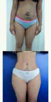 44 Year Old Woman Treated With Tummy Tuck, Lipo And BBL By Dr Kemil Issa, MD, Dominican Republic Plastic Surgeon