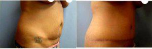46 Year Old Woman Treated With Tummy Tuck And Liposuction By Doctor Christopher W. Chase, MD, Chattanooga Plastic Surgeon