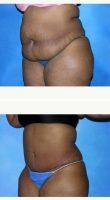 46 Yr Old Female - Tummy Tuck With Liposuction Of Flanks With Dr. Robert Frank, MD, Munster Plastic Surgeon
