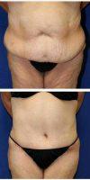 48 Year Old Woman Treated With Tummy Tuck And Liposuction Of Abdomen And Flanks With Doctor Zoran Potparic, MD, Fort Lauderdale Plastic Surgeon