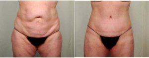 49 Year Old Woman Treated With Tummy Tuck And Liposuction With Doctor R. Scott Yarish, MD, Houston Plastic Surgeon