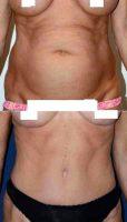 49 Year Old Woman Treated With Tummy Tuck, Muscle Repair, And BodyTite Liposuction By Dr Peter Bray, MD, Toronto Plastic Surgeon