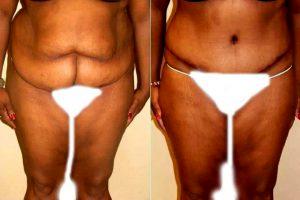 50 Year Old Abdominoplasty Tummy Tuck And Liposuction To Flanks By Dr Thomas G. Liszka, MD, Charlotte Plastic Surgeon