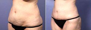 50 Yr Old Wanting Tummy Tuck And Liposuction By Dr Grant Stevens, MD, Los Angeles Plastic Surgeon