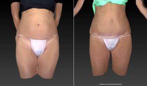 51 Year Old Woman For Mini Tummy Tuck And Liposuction By Dr. Pouria Moradi, MBBS, FRACS, Sydney Plastic Surgeon