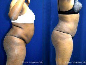 51 Year Old Woman Treated With Abdominoplasty And Liposuction With Dr Ricardo L. Rodriguez, MD, Baltimore Plastic Surgeon