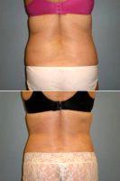 52 Y.O Woman, Full Abdominoplasty And Bilateral Flank Liposuction. By Dr. Heather Rocheford, MD, Minneapolis Plastic Surgeon