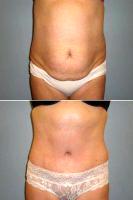 52 Y.O Woman, Full Abdominoplasty And Bilateral Flank Liposuction. With Dr. Heather Rocheford, MD, Minneapolis Plastic Surgeon