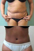 53 Year Old Female- Tummy Tuck With Liposuction Of Hips And Flanks With Dr Robert Heck, MD, FACS, Columbus Plastic Surgeon