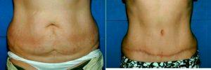 53 Year Old Woman With Stretch Marks And Redundant Skin With Dr Dean E. Sorensen, MD, Boise Plastic Surgeon