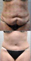 53-year-old Woman Undergoes Tummy Tuck And Liposuction By Dr Jeffrey Rockmore, MD, Albany Plastic Surgeon