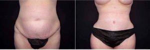 54 Year Old Woman Treated With Tummy Tuck And Circumferential Liposuction With Dr. Landon Pryor, MD, FACS, Rockford Plastic Surgeon