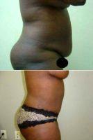 56 Year Old Tummy Tuck And Liposuction By Dr. Andrew Jimerson, MD, Atlanta Plastic Surgeon