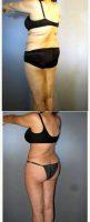 56 Year Old Woman Tummy Tuck Liposuction By Dr Henry Mentz, MD, FACS, Houston Plastic Surgeon