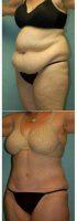 58 Year Old Woman, 5'6_, 188 Lbs. Four Months After Lipoabdominoplasty Before With Doctor Robert M. Lowen, MD, Mountain View Plastic Surgeon