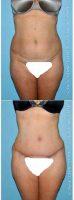 58 Year Old Woman Treated With Tummy Tuck - Liposuction Hips Flanks (PAL) With Dr Jose Perez-Gurri, MD, FACS, Miami Plastic Surgeon