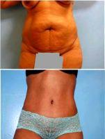 6 Month Post Operative Abdominoplasty For Stretch Marks By Dr Norman G. Morrison, MD, FACS, New York Plastic Surgeon (1)