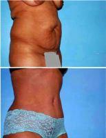 6 Month Post Operative Abdominoplasty For Stretch Marks By Dr Norman G. Morrison, MD, FACS, New York Plastic Surgeon (2)