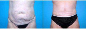63 Year Old Woman Treated With Tummy Tuck And Liposuction 4 Weeks Post-op By Dr Landon Pryor, MD, FACS, Rockford Plastic Surgeon