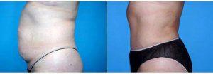 63 Year Old Woman Treated With Tummy Tuck With Circumferential Liposuction By Dr. Landon Pryor, MD, FACS, Rockford Plastic Surgeon