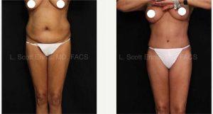 65 Year Old Female With Abdominoplasty Tummy Tuck And Liposuction Of The Hips With Dr. Lawrence Scott Ennis, MD, FACS, Pensacola Plastic Surgeon