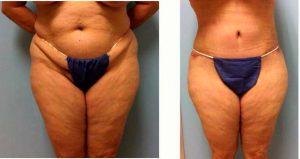 68 Year Old Woman Treated With Tummy Tuck With Liposuction To Flanks By Doctor Paul S. Gill, MD, Houston Plastic Surgeon